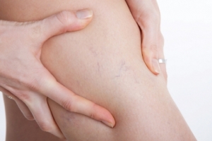 Những môn thể thao và thực phẩm có lợi cho người bị suy giãn tĩnh mạch